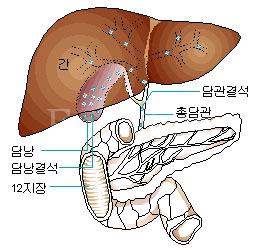 담석.jpg